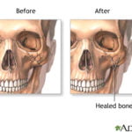 First cell phone implant at Mao Clinic