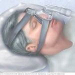 Snoring Machine Perfected